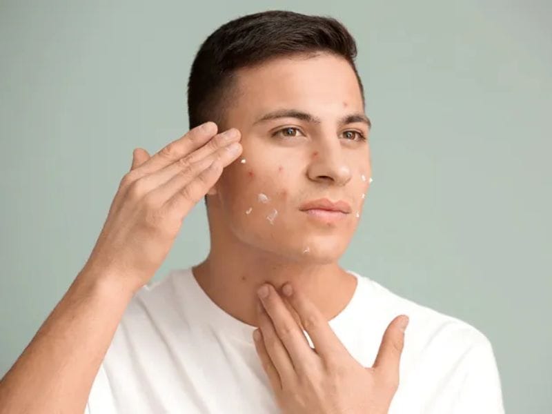 Dùng Kem Trị Mụn Cho Nam