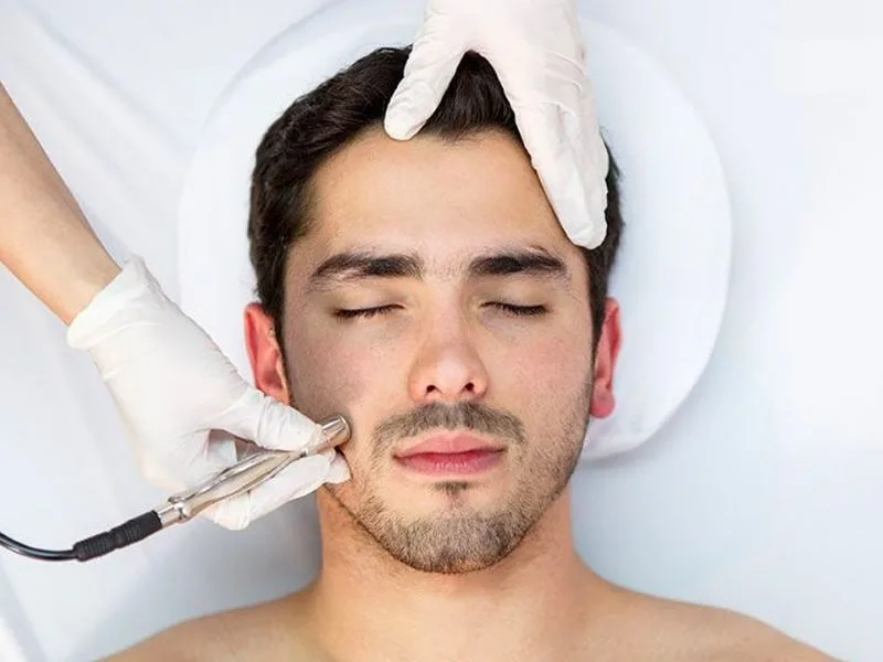 Trị Mụn Nam Bằng Các Phương Pháp Công Nghệ